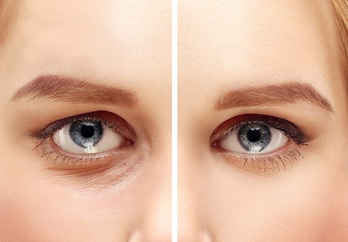 Corectarea cearcănelor cu acid hialuronic în Iași
