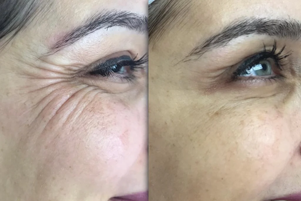 Tratament Botox cu toxină botulinică în Iași pentru riduri de expresie