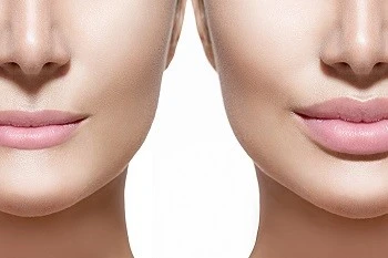 Augmentare buze cu acid hialuronic în Iași