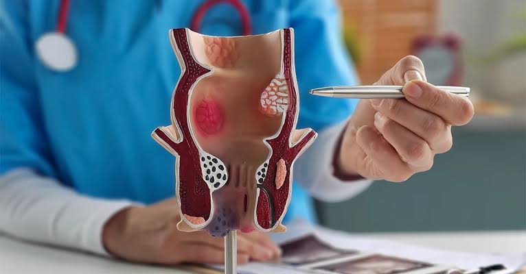 Tratament hemoroizi în Iași - proctologie - Centrul Medical Tudor